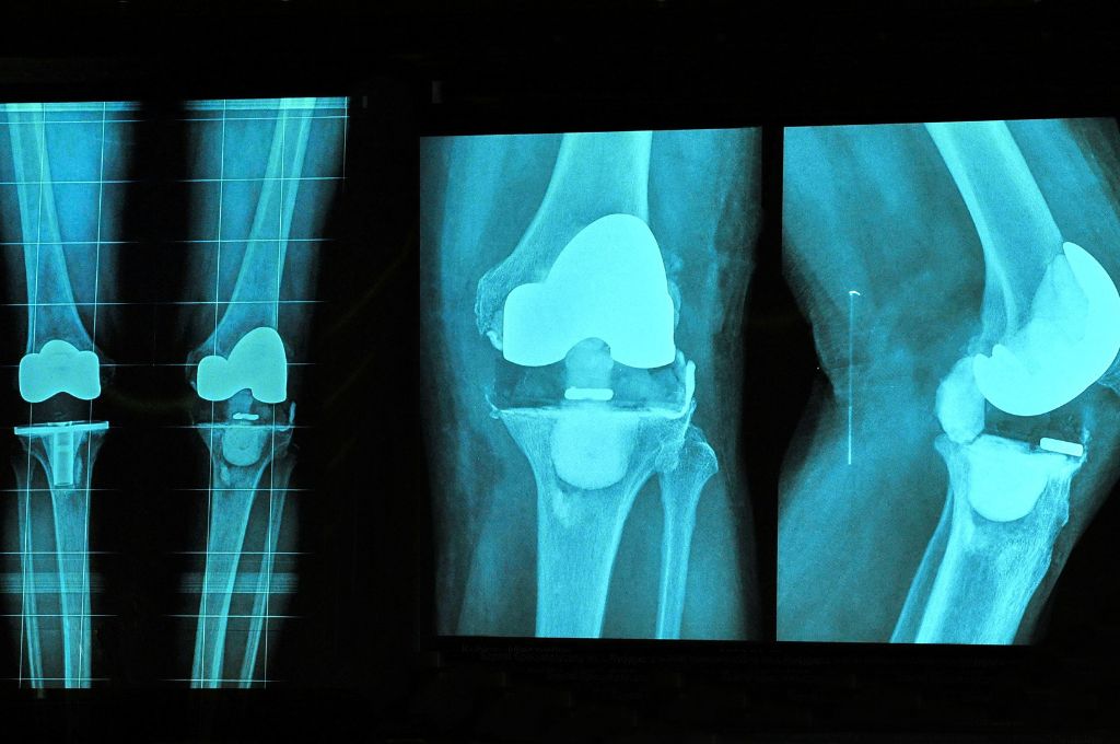X-ray of knee replacement
